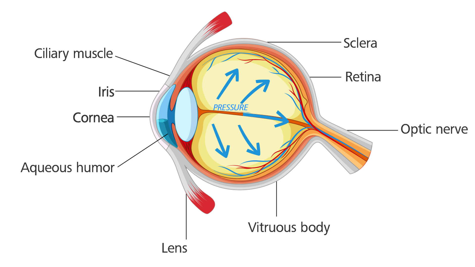 Olho com glaucoma: a tensão ocular aumenta e lesiona o nervo ótico.